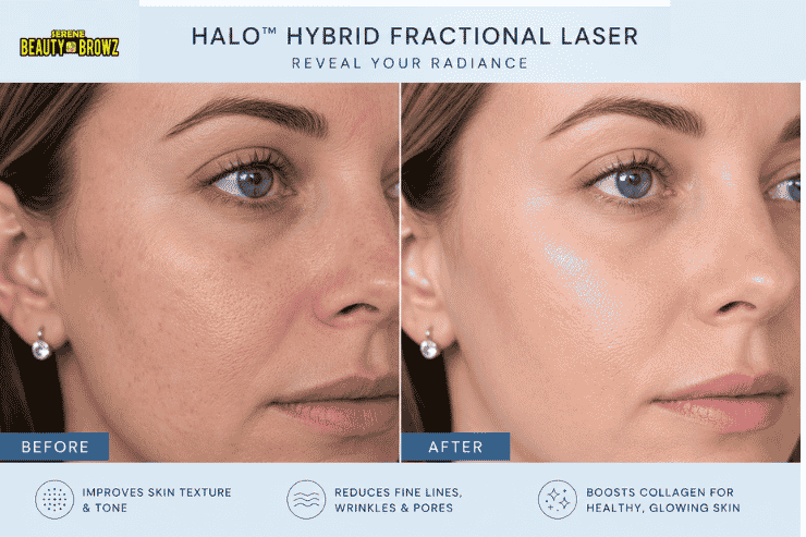 Halo face treatment before and after results at Serene Beauty & Browz, Warren and Sterling Heights Michigan